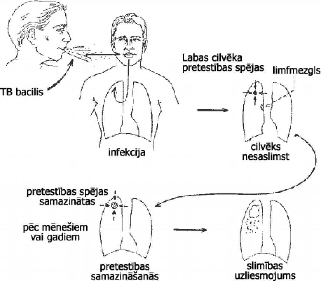 Latvijā pieaug saslimstība ar tuberkulozi