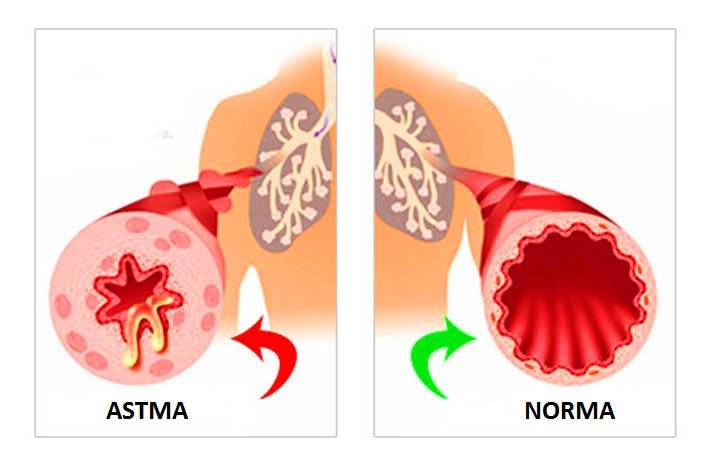 Ārste: pacientiem ir grūti atzīt diagnozi - astma