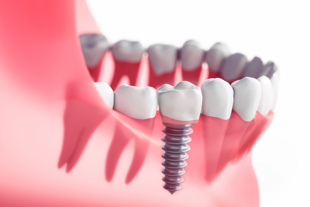 Kādos gadījumos ir vērts apsvērt zobu implantus